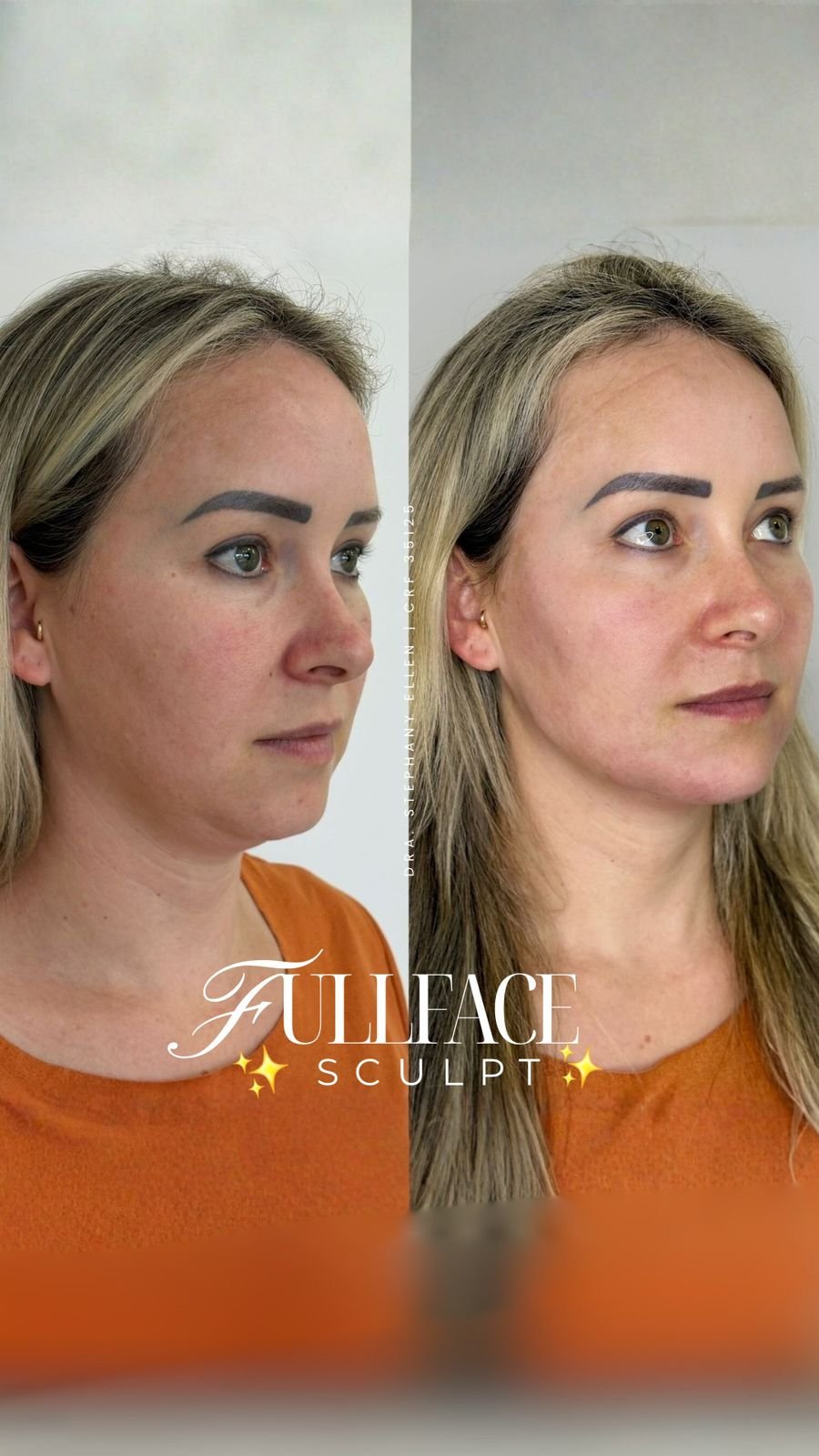 Preenchimento com Acido Hialuronico em Curitiba 1