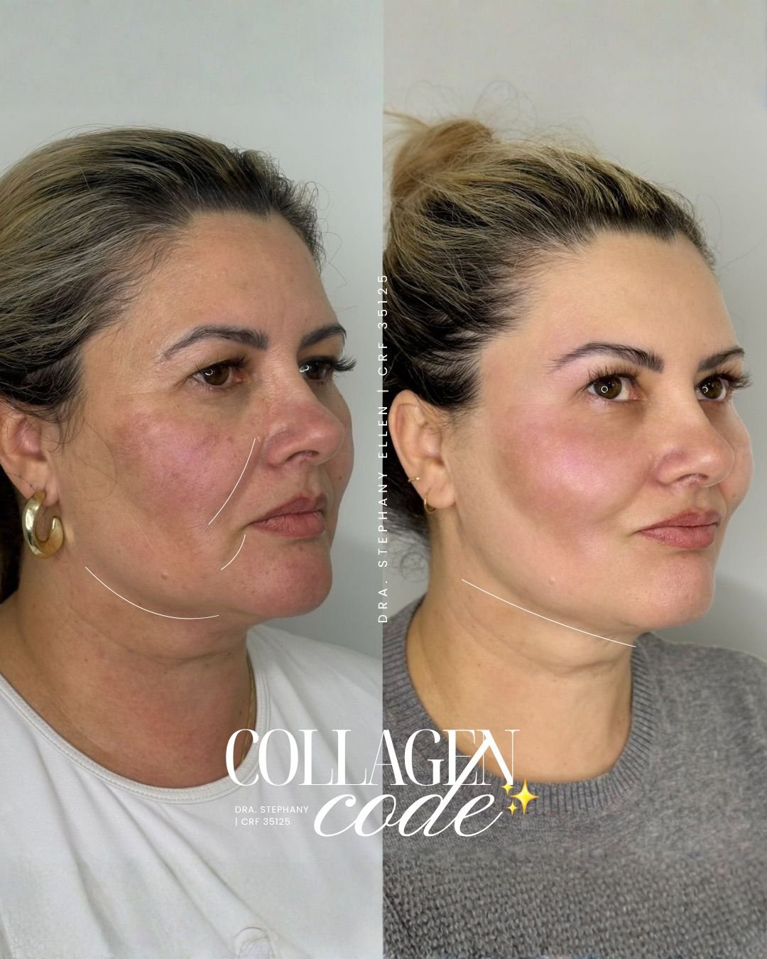 Sculptra Curitiba Clinica Especializada