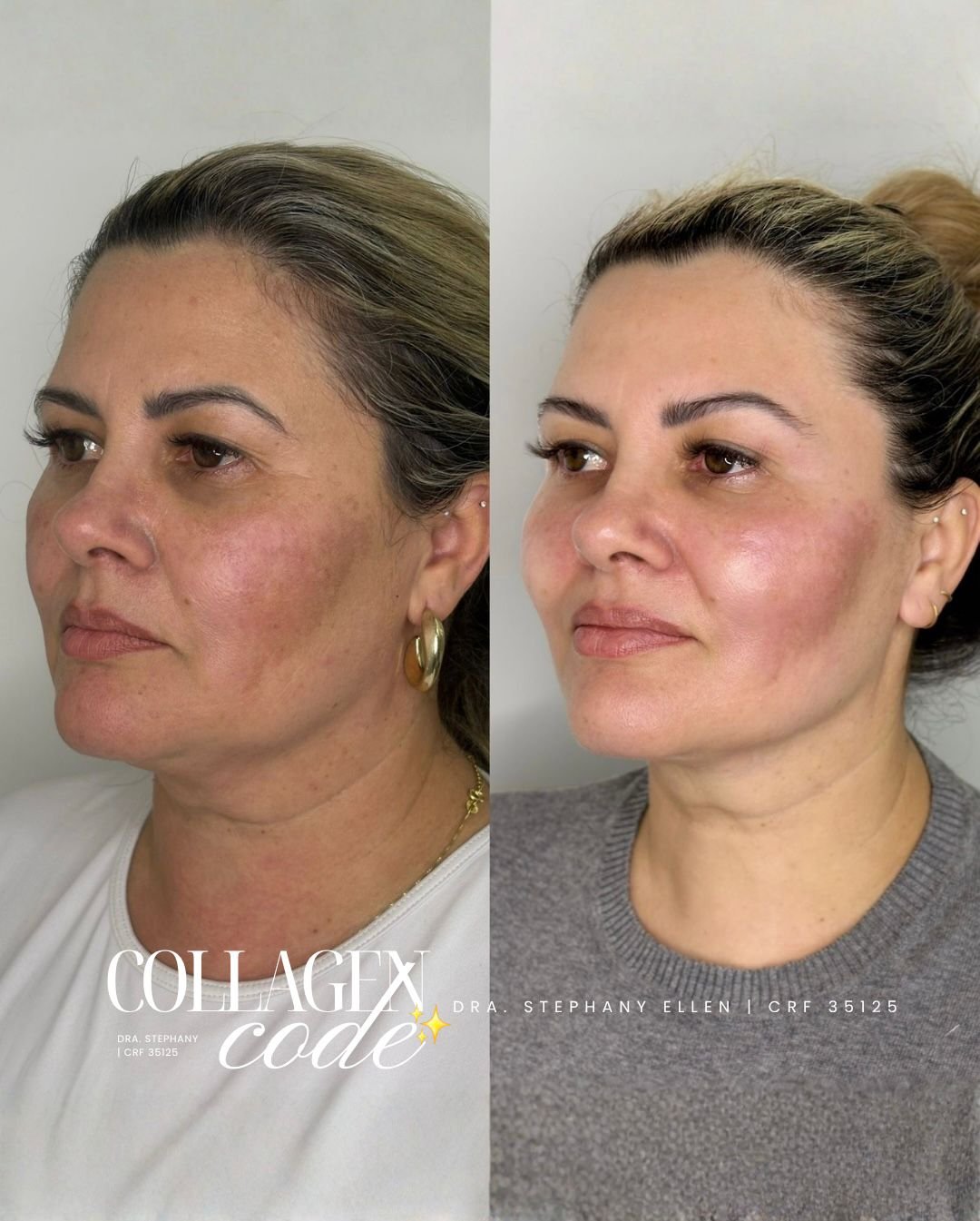 Sculptra em Curitiba