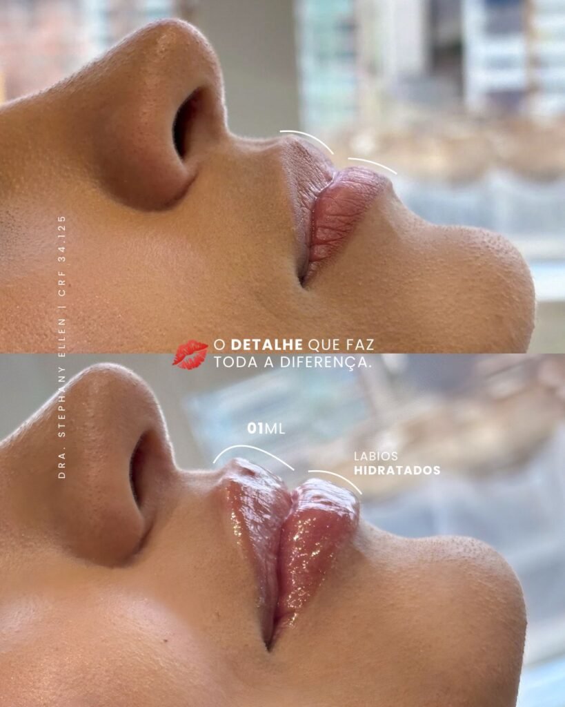 preenchimento labial curitiba