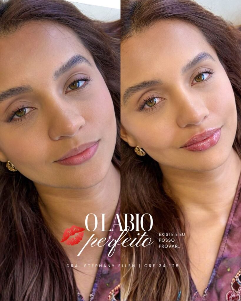 preenchimento labial em curitiba
