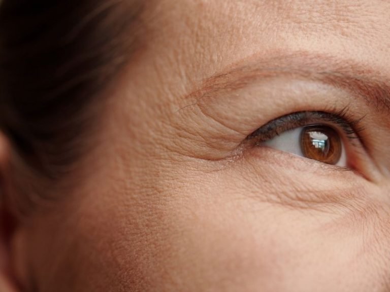 Laser para melasma Curitiba