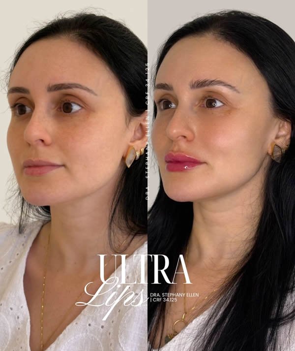 ultrassom microfocado curitiba